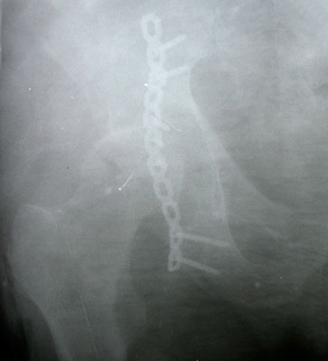 Фото 3_На рентген-снимке - остеосинтез вертлужной впадины