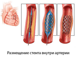 Фото 7_Стент внутри артерии -схема