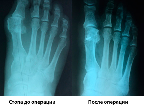 Вальгусная деформация стопы - рентген до и после операции
